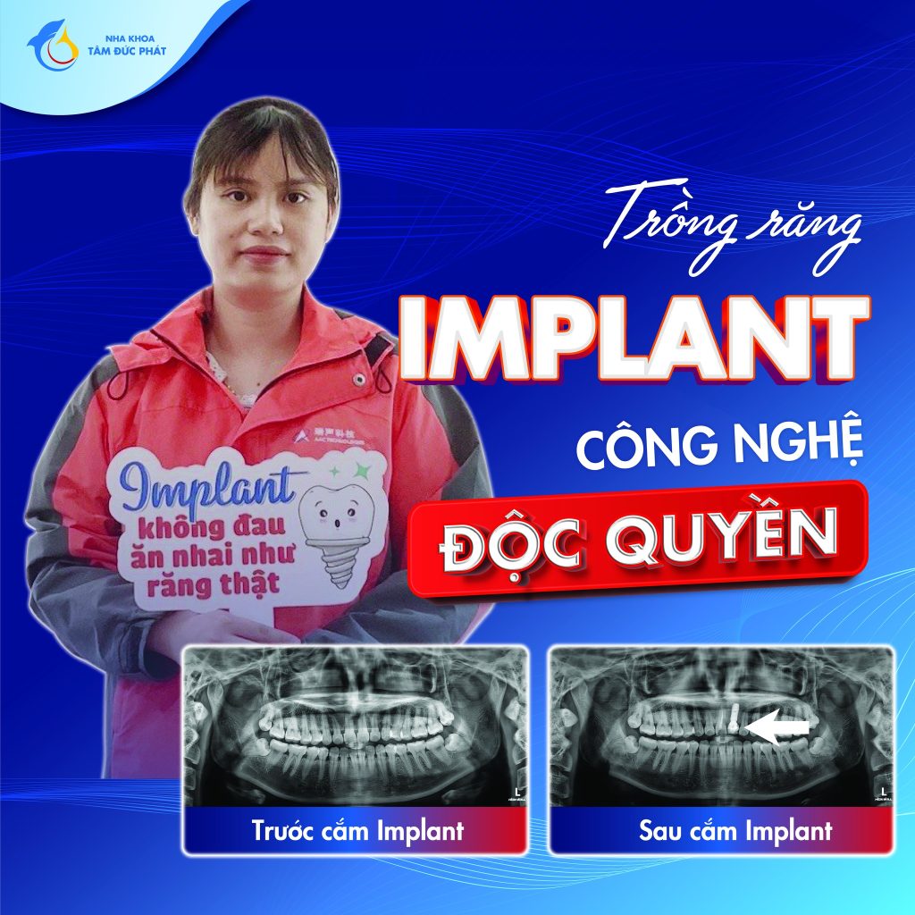 trồng răng implant bắc ninh