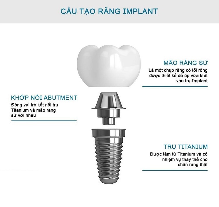 trồng răng implant bắc ninh