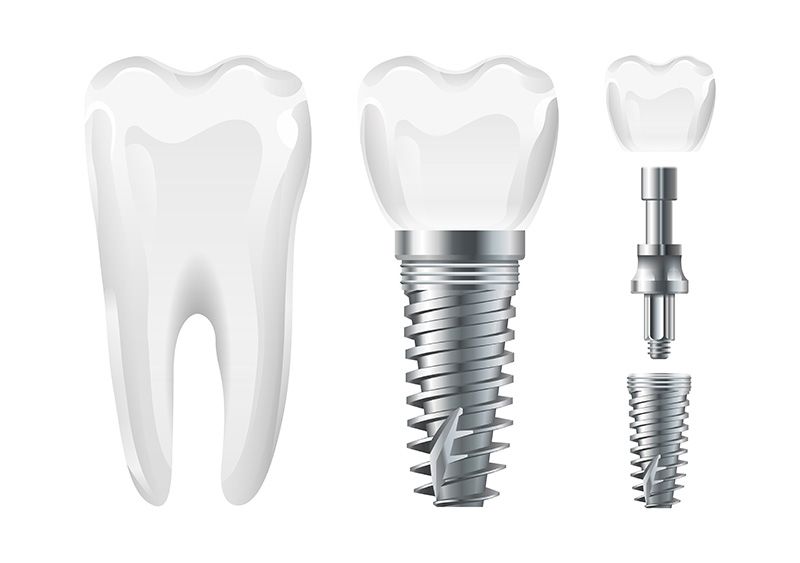 trồng răng implant bắc ninh