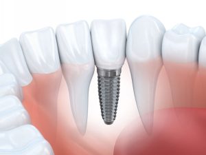 Bị Tiêu Xương Hàm Có Trồng Răng Implant Được Không? Giải Đáp