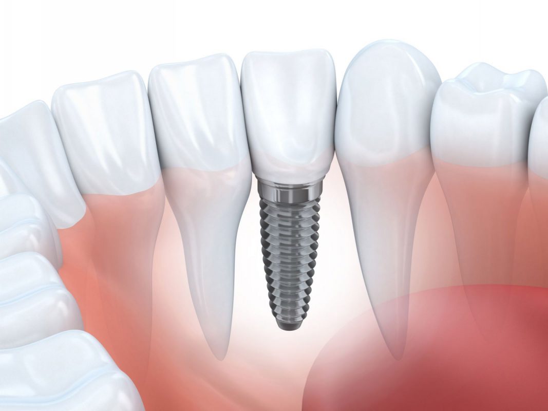 Bị Tiêu Xương Hàm Có Trồng Răng Implant Được Không? Giải Đáp