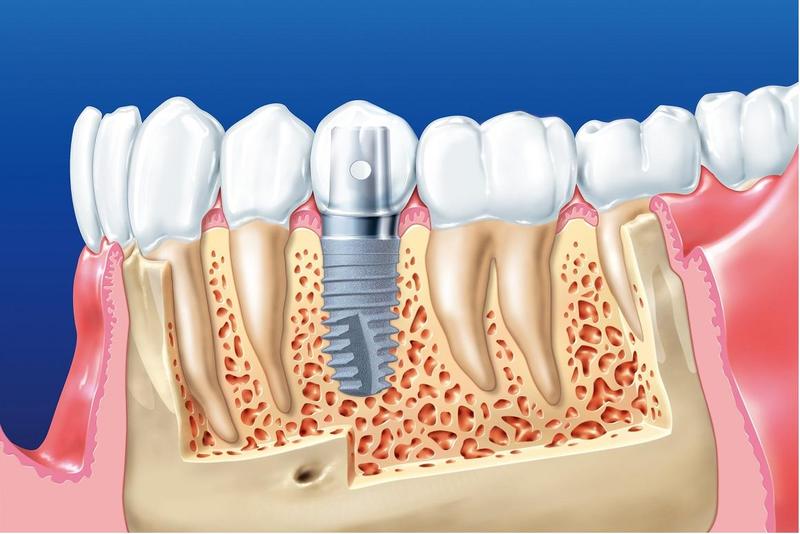 trồng răng implant bắc ninh