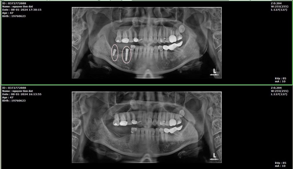 trồng răng implant bắc ninh