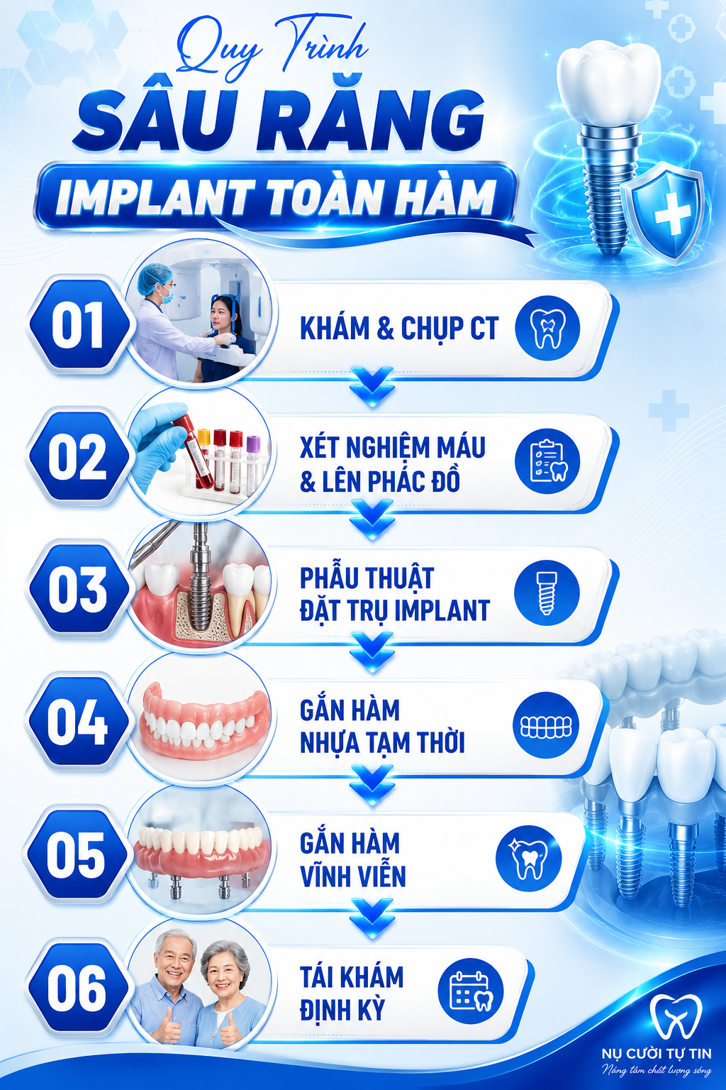 trồng implant toàn hàm bắc ninh