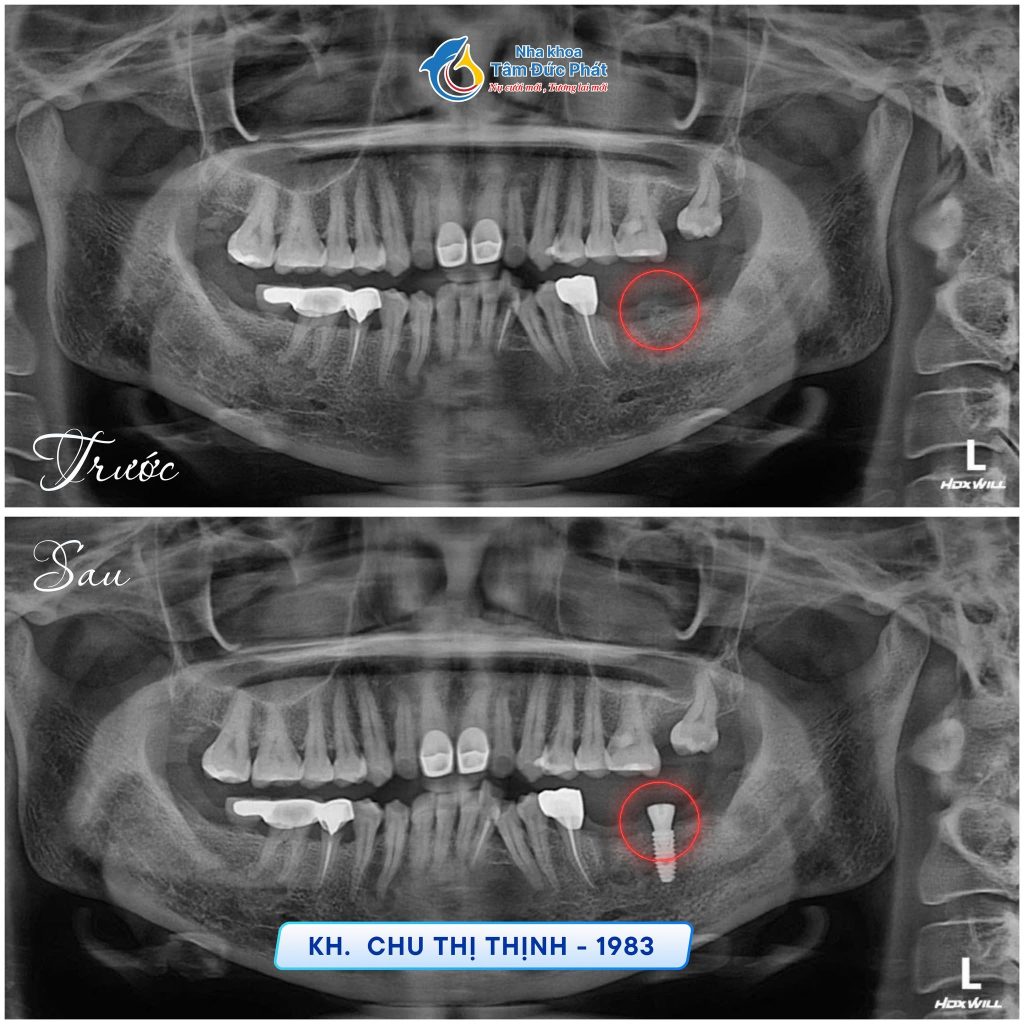 Địa Chỉ Trồng Răng Implant Tại Bắc Ninh Uy Tín – Nha Khoa Tâm Đức Phát 1 dia-chi-trong-rang-implant-tai-bac-ninh