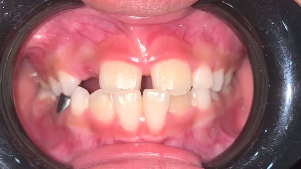 Niềng Răng Uy Tín Cho Học Sinh Sinh Viên Tại Bắc Ninh | Trả Góp 0% 1 Niềng răng uy tín cho học sinh sinh viên tại Bắc Ninh
