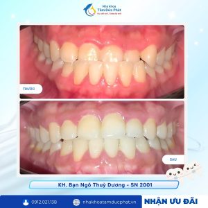So sánh răng sứ titan và răng sứ trên implant