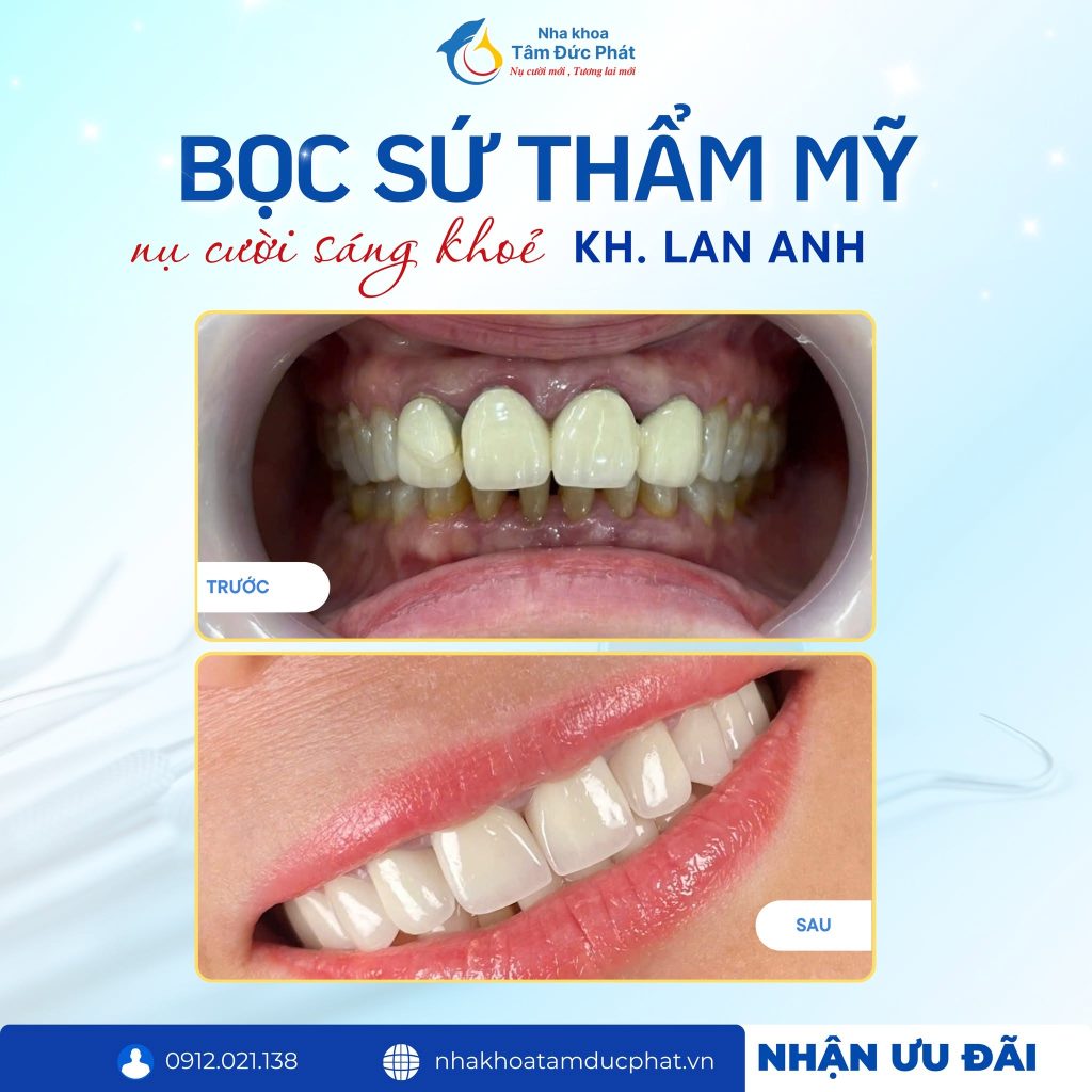 Bọc răng sứ có bị hôi miệng không nguyên nhân do đâu?
