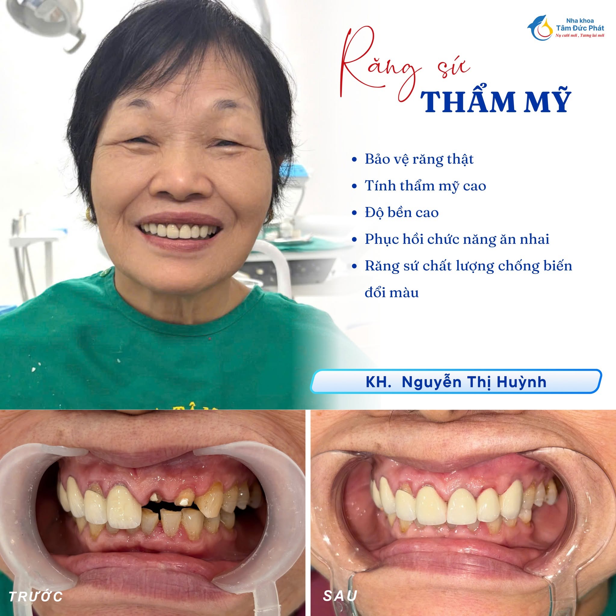 Một số dịch vụ nha khoa sẽ không được bảo hiểm y tế chi trả