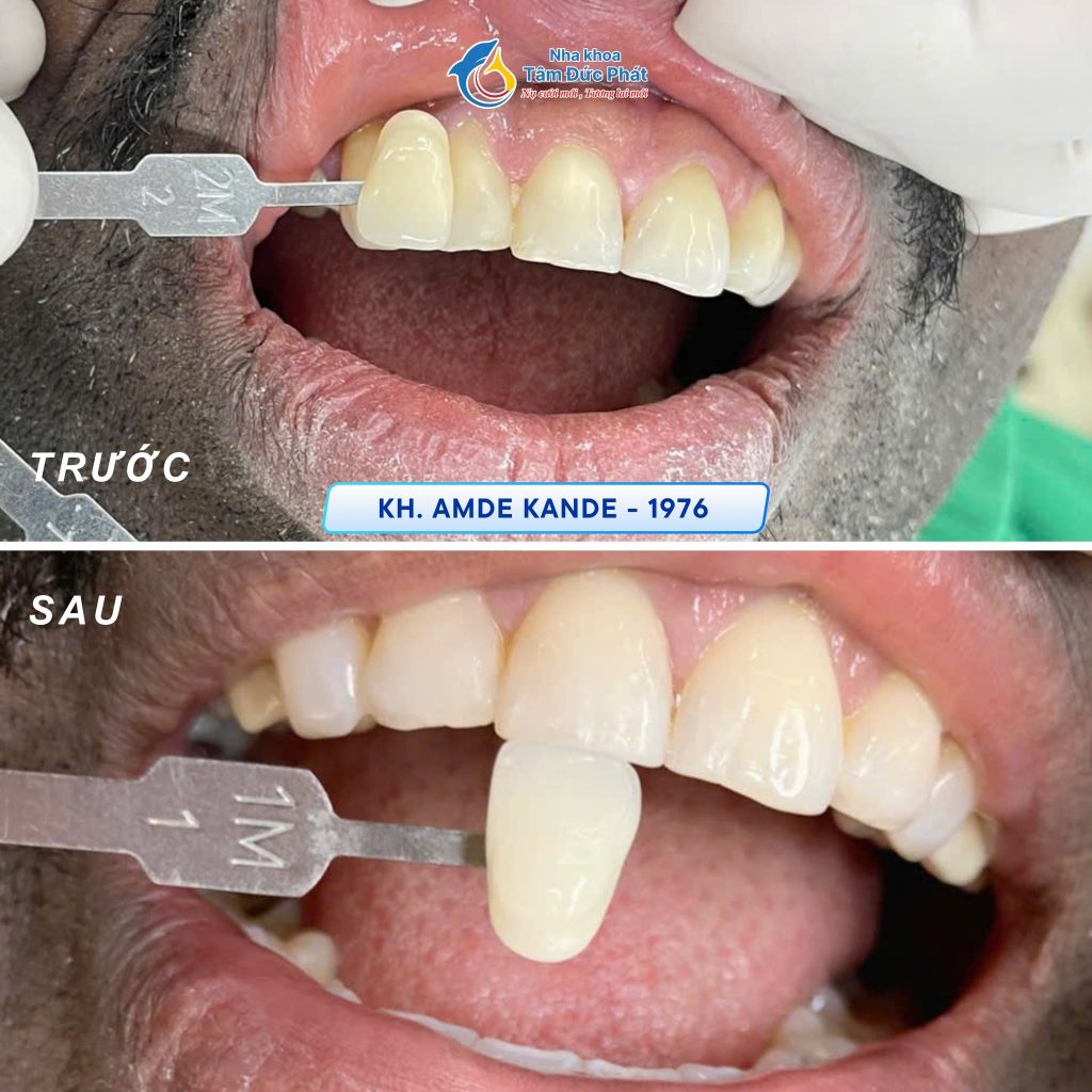 Lý Do Răng Sứ Veneer Siêu Mỏng Trở Thành Xu Hướng Thẩm Mỹ Hàng Đầu