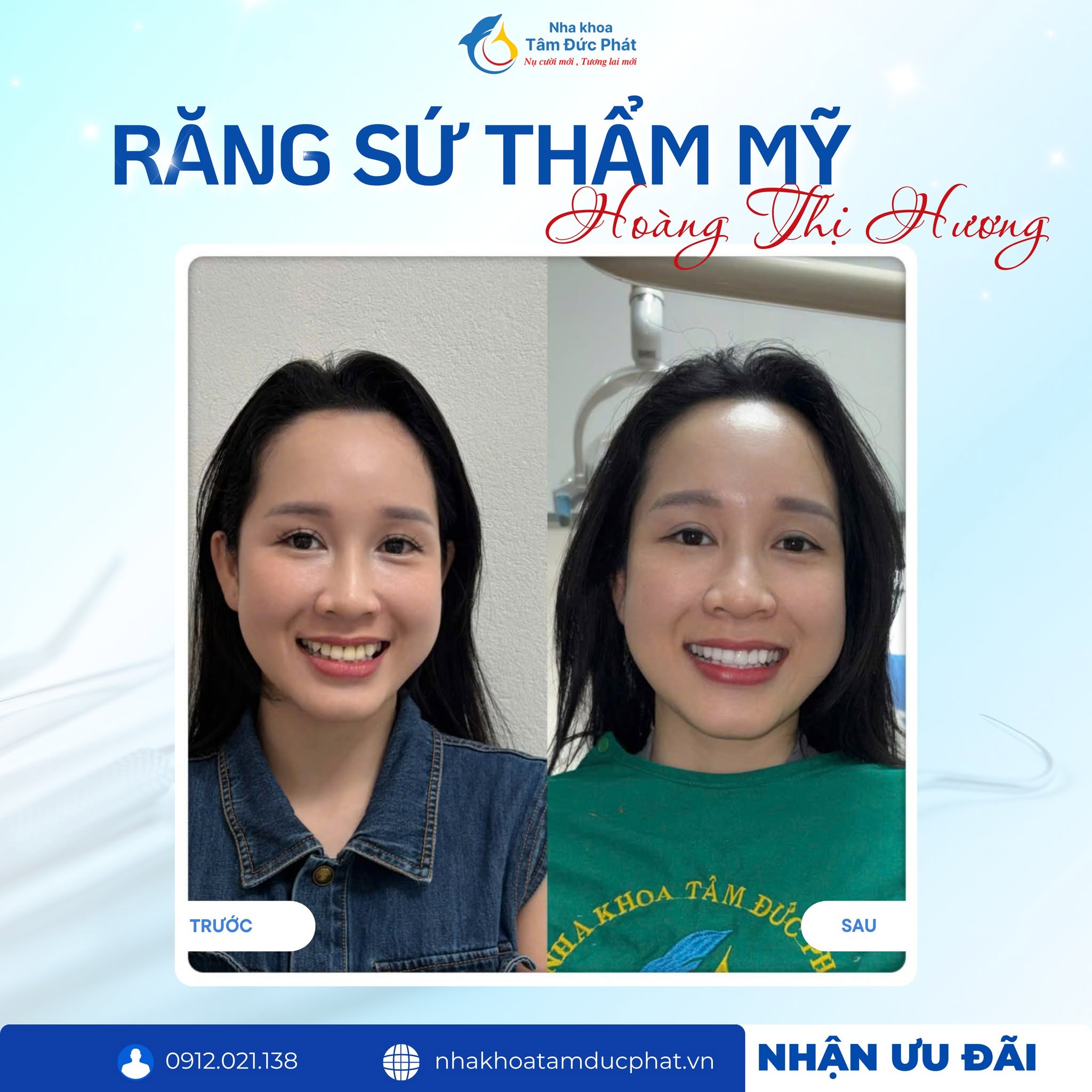 Răng sứ Veneer siêu mỏng không mài răng