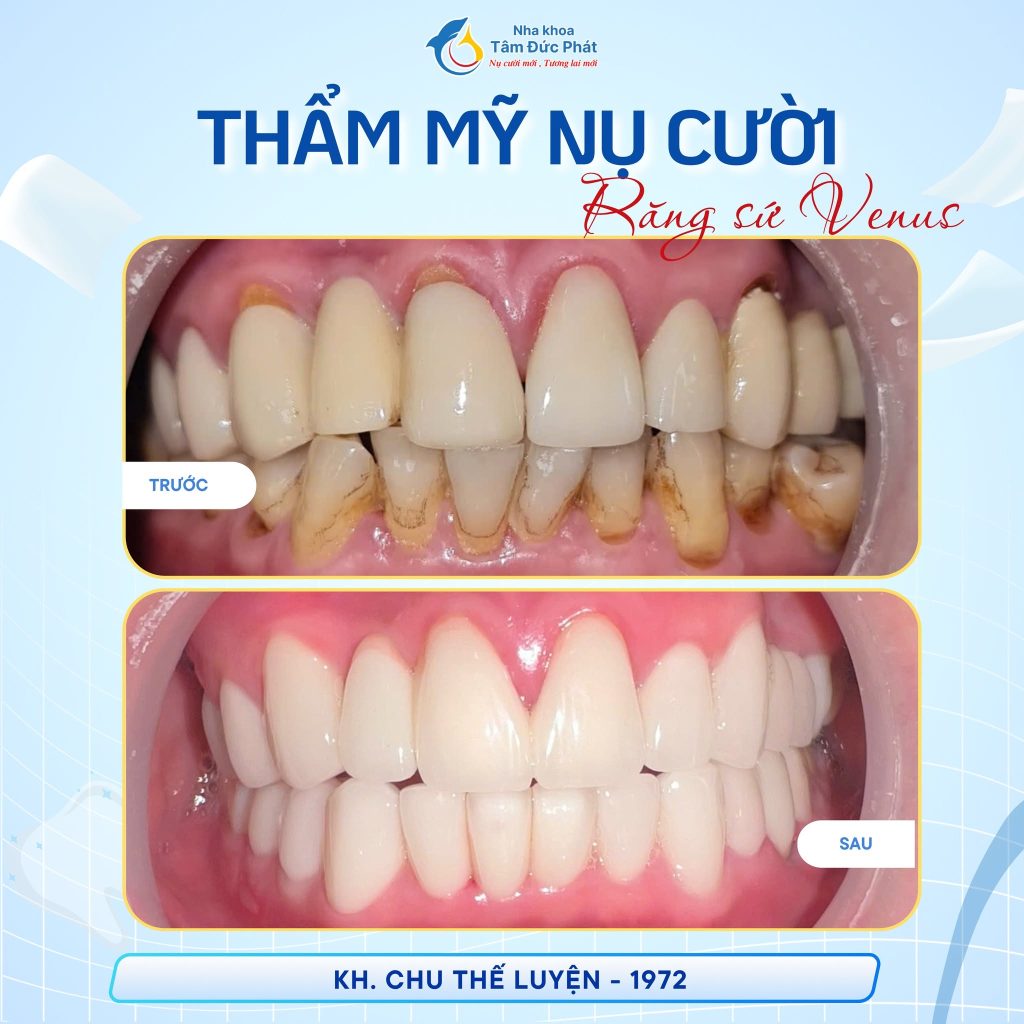 Review Nha Khoa Uy Tín Tại Bắc Ninh Công Khai Chi Phí - 4 Tiêu Chí Vàng Lựa Chọn 2 Dịch vụ thẩm mỹ nụ cười Nha Khoa Tâm Đức Phát