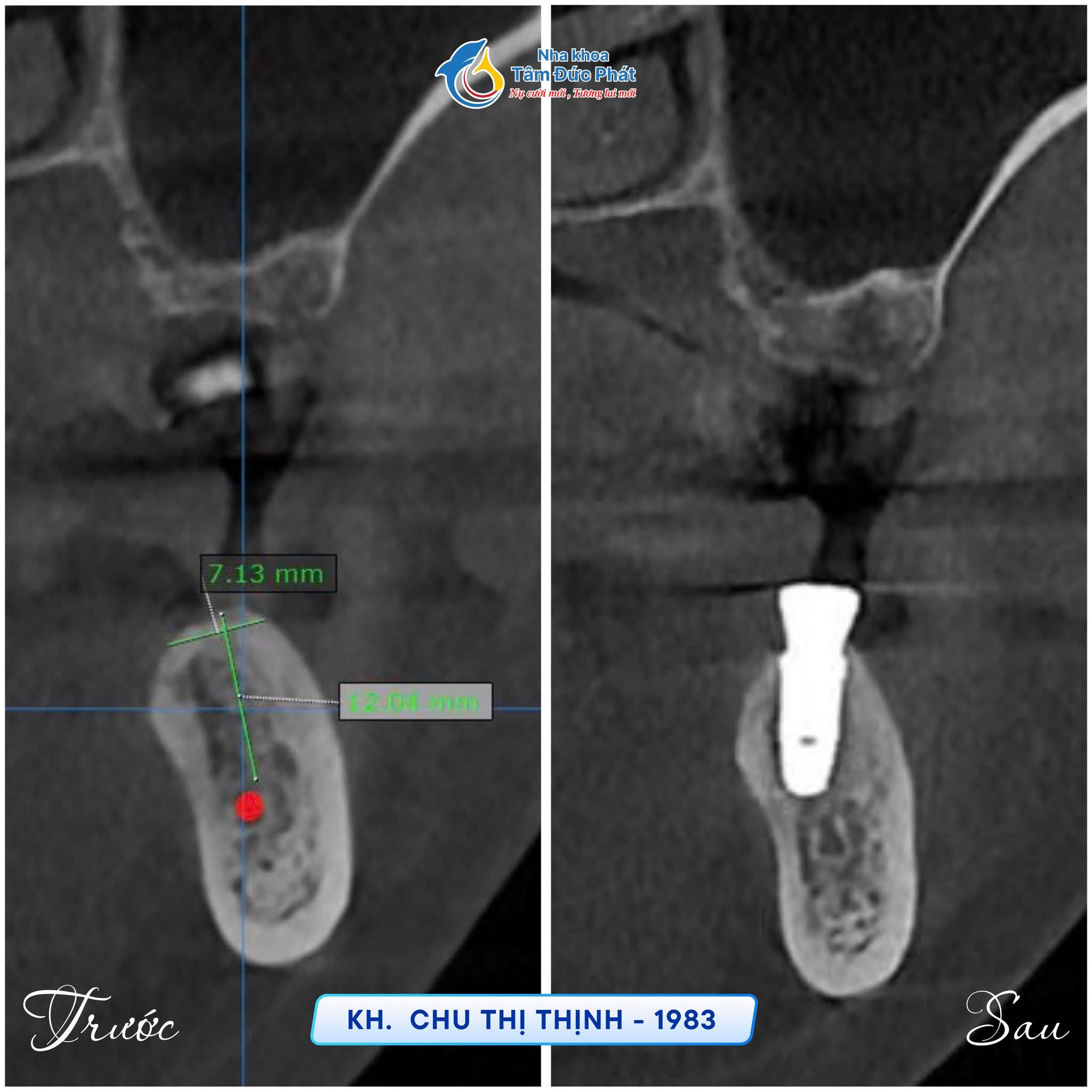 Giá trồng răng implant tại Bắc Ninh bao nhiêu? Gồm những chi phí nào?