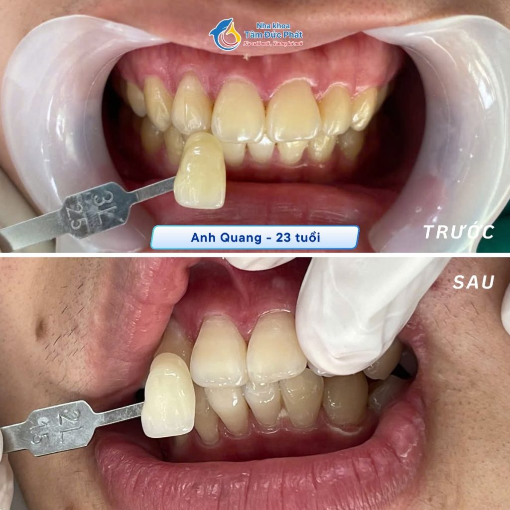 Cách lựa chọn răng sứ phù hợp