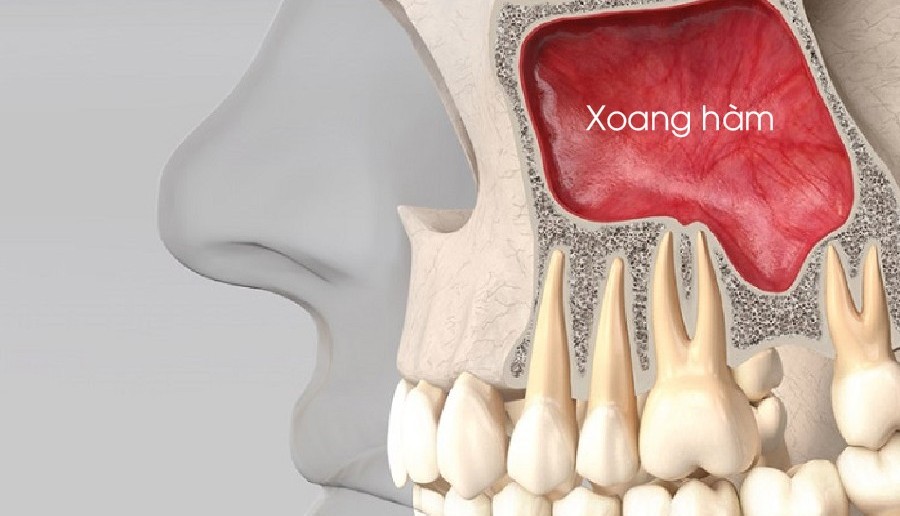 Dán sứ veneer có bền không có bị hôi miệng không? Giải đáp y khoa 2 Một số nguyên nhân Dán sứ bị hôi miệng