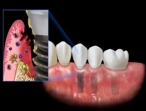 Biến Chứng Cấy Implant Tại Nha Khoa Kém Chất Lượng