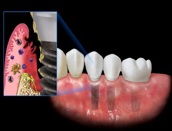 5 Biến Chứng Cấy Implant Tại Nha Khoa Kém Chất Lượng | Lời khuyên từ chuyên gia 1 Biến Chứng Cấy Implant Tại Nha Khoa Kém Chất Lượng
