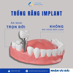Giải đáp y khoa: Cấy ghép răng implant có đau không?