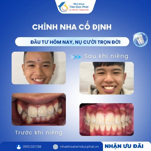 Những trường hợp bắt buộc phải nhổ răng khi niềng