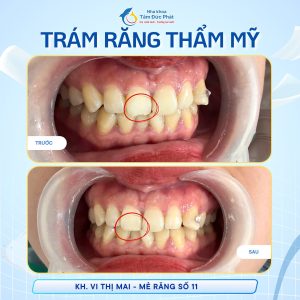 Thiết kế nụ cười Smile Design tại Bắc Ninh