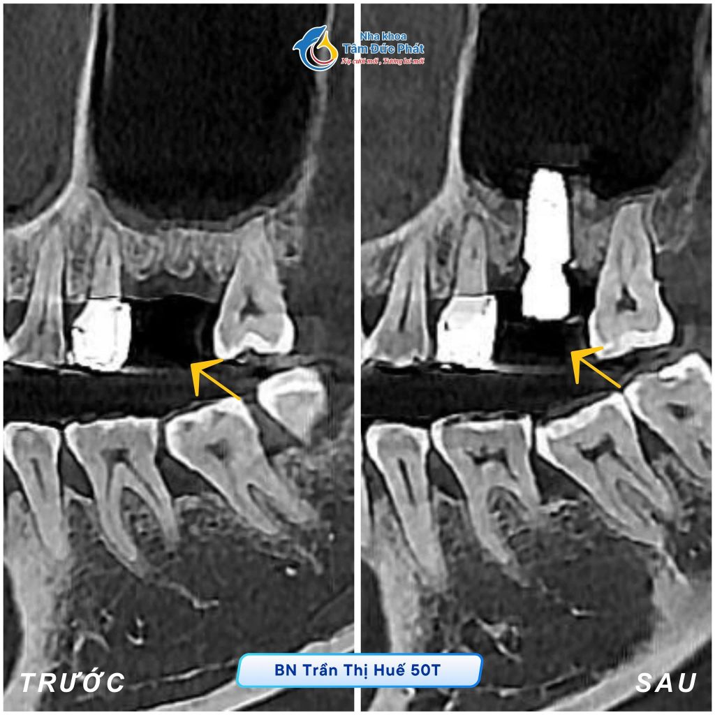 TRỒNG RĂNG IMPLANT CHO NGƯỜI GIÀ CẦN LƯU Ý GÌ? NHA KHOA TÂM ĐỨC PHÁT 2 Chụp CT kỹ lưỡng trước khi Trồng răng implant cho người già