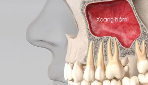 Trồng răng implant mất bao lâu thì ăn nhai được