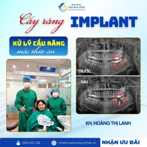 Có nên trồng răng implant giá rẻ không