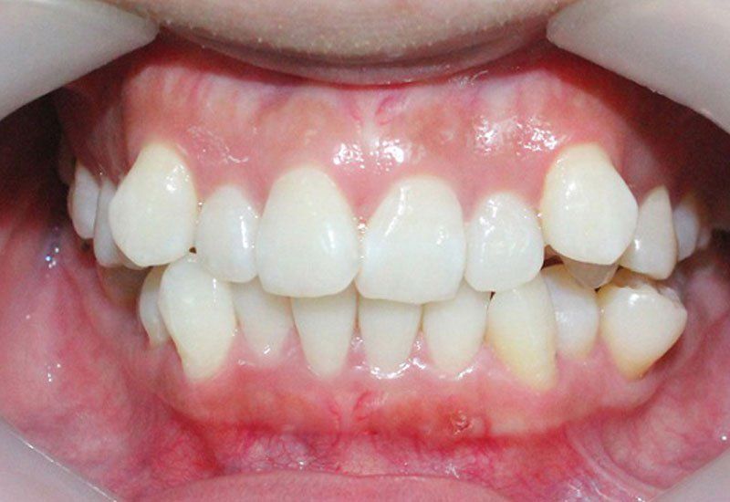 CÓ NÊN DÁN SỨ VENEER CHO RĂNG KHẤP KHỂNH KHÔNG? GIẢI ĐÁP Y KHOA 1 Có nên dán sứ Veneer cho răng khấp khểnh không?