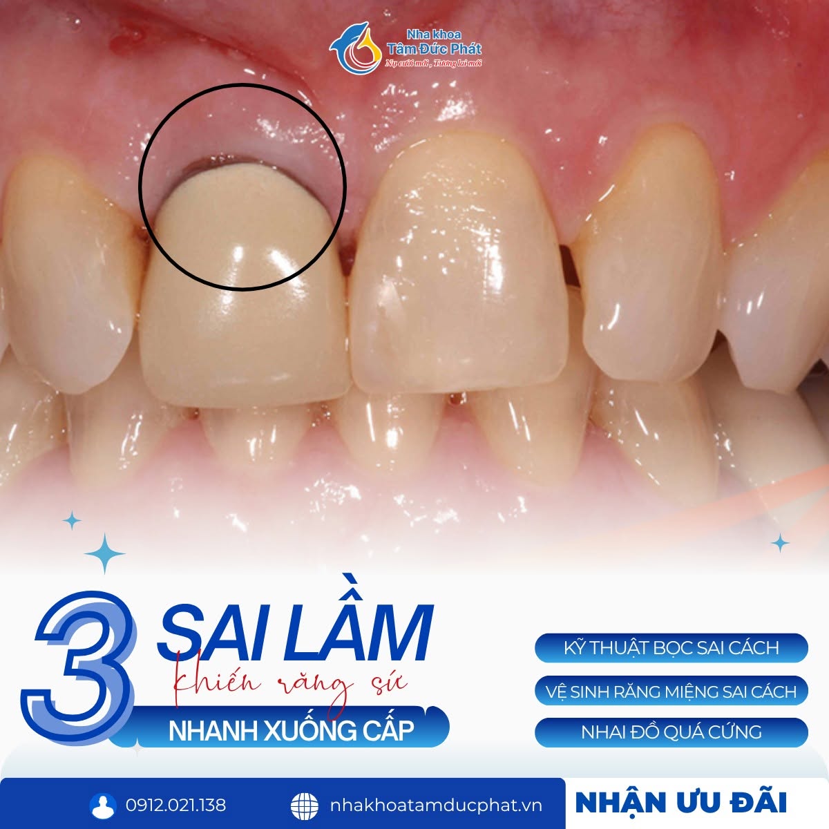 Tác hại của việc bọc răng sứ giá rẻ tại cơ sở chui
