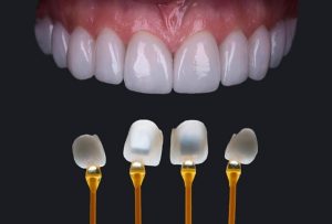 Nên bọc răng sứ Cercon hay Emax?