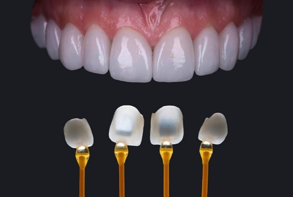 Nên bọc răng sứ Cercon hay Emax?